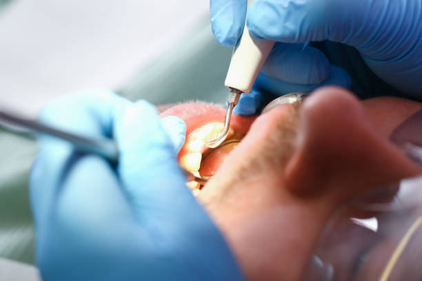 Best Emergency Wisdom Teeth Removal in Bronte, TX